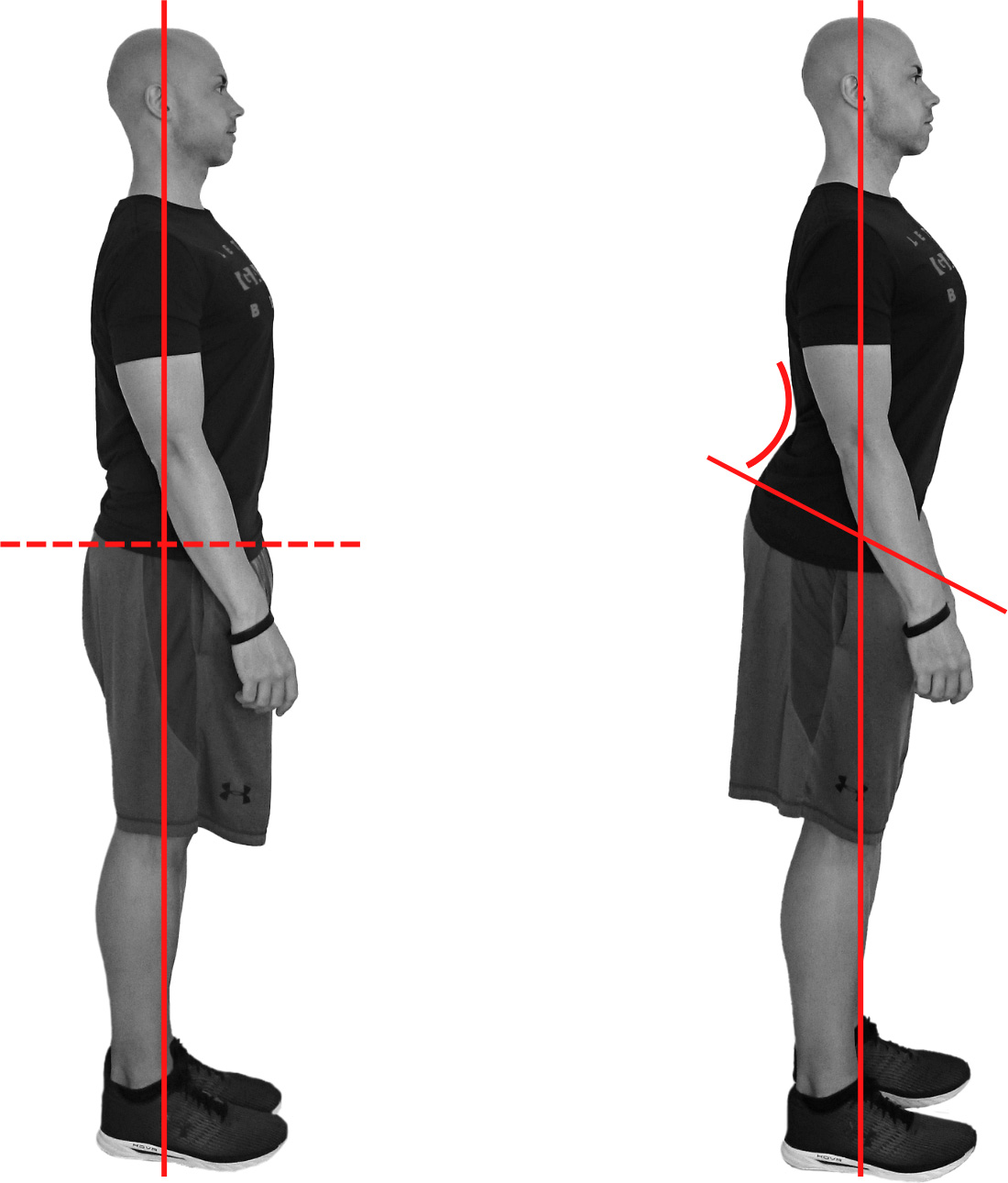 Hollow back increased lumbar lordosis